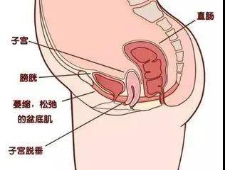 赴美生子产后宝妈盆肌底修复有必要吗？